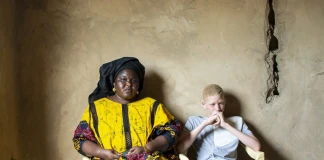 Албинос в Сенегал